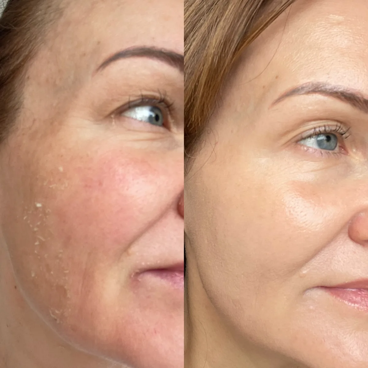 Vorher-Nachher-Vergleich einer HydraFacial™ Behandlung: sichtbar beruhigtes, ebenmäßigeres Hautbild