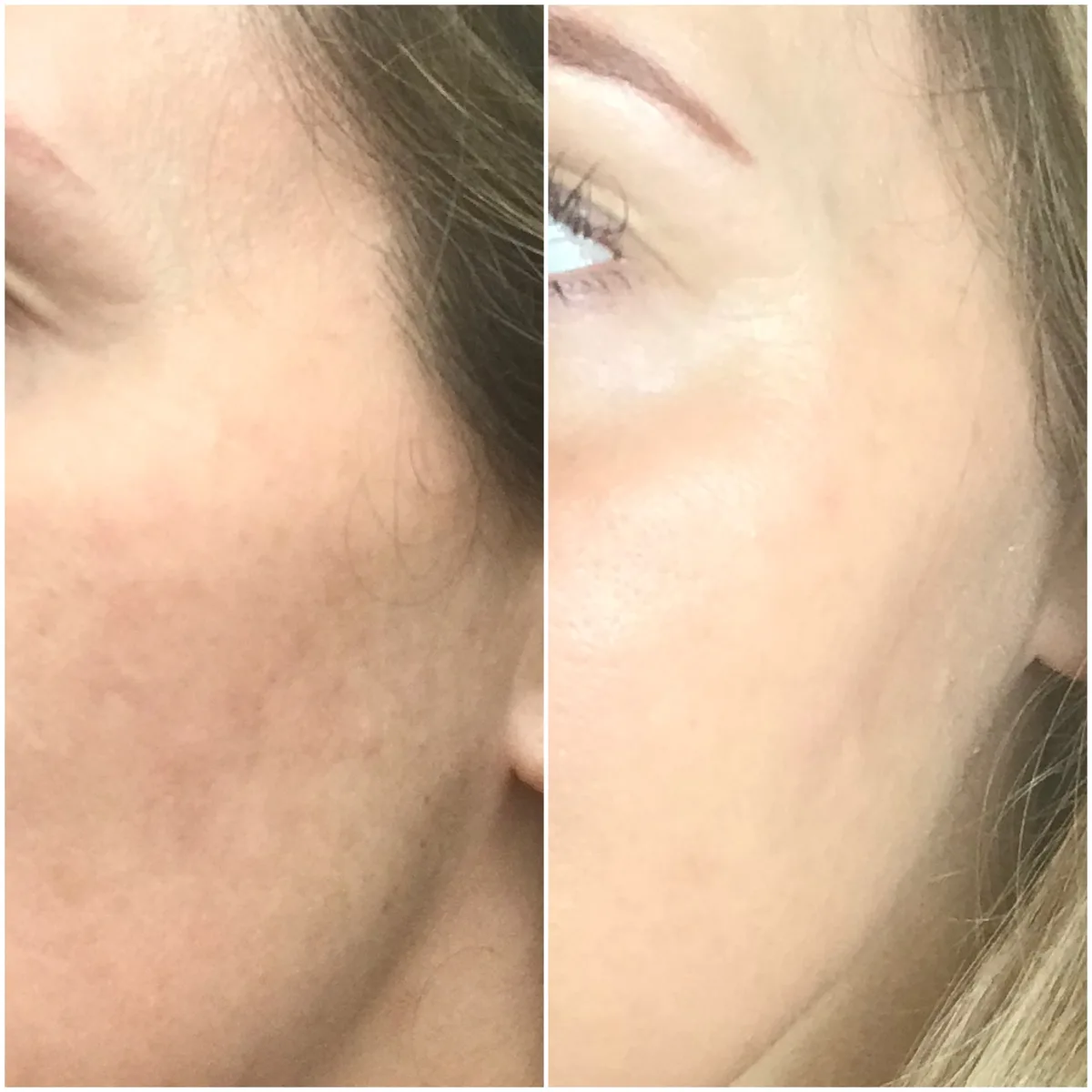 Vorher-Nachher-Vergleich einer SkinPen® Precision Behandlung: feinere Hautstruktur und verfeinerte Poren