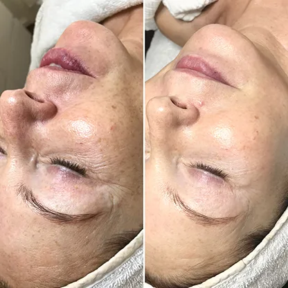 Vorher-Nachher-Vergleich einer INFUZION® System Behandlung: geglättete Linien und pralleres Hautbild